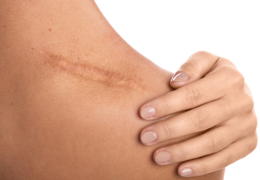 Le 5 regole d’oro per prenderti cura delle cicatrici | Guida completa