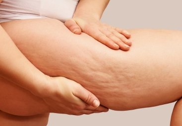 Come Riconoscere il Lipedema e Distinguerlo dalla Cellulite