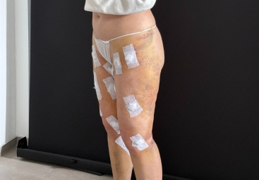 Recupero dopo liposuzione per lipedema: La guida completa 