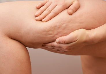 Cellulite: medicina occidentale, cinese e Ayurveda