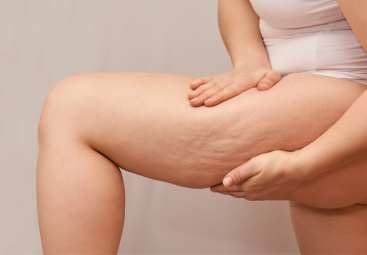 Cellulite: cos’è davvero e come migliorare la salute della pelle con compressione e collagene